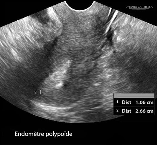 Endomètre polypoïde — aspect hystéroscopique irrégularité cavité utérine