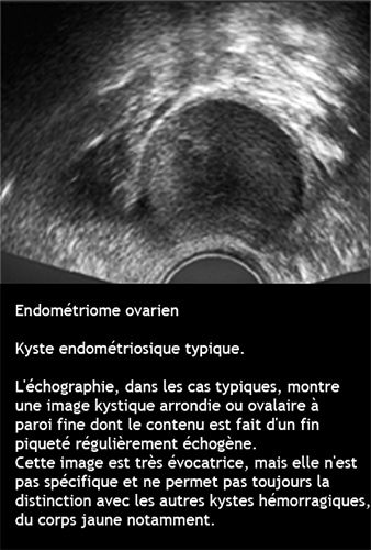 Endométriome 1