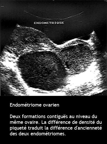 Endométriome 10