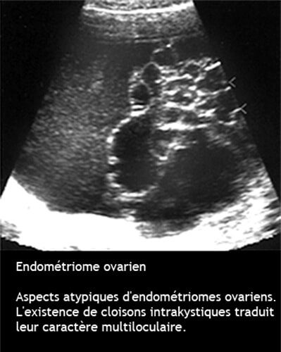 Endométriome 13