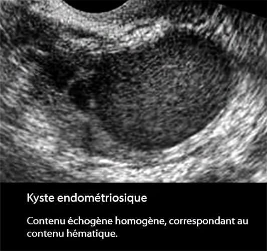 Endométriome 5