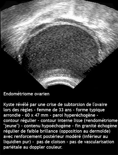 Endométriome 6