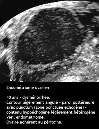 Endométriome 8