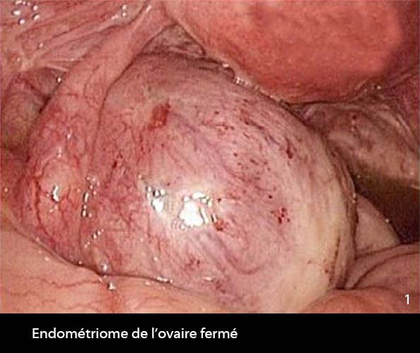 Endométriome fermé 1_2