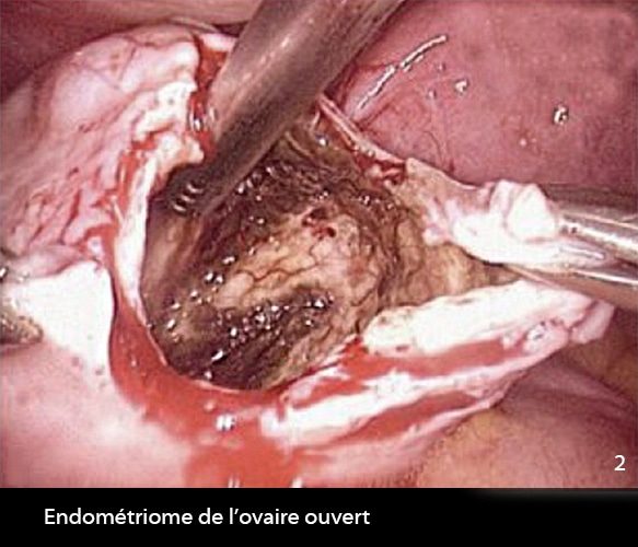 Endométriome ouvert 2_2