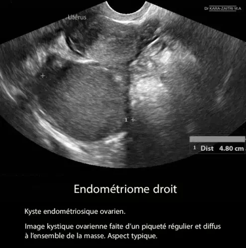 Échographie d'un endométriome ovarien