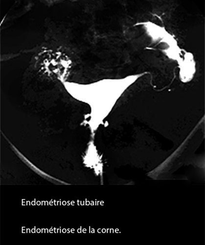 Endométriose corne utérine — lésion endométriosique cornuale coelioscopie