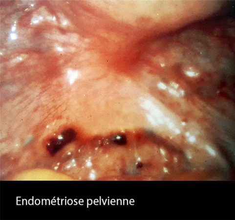 Endométriose externe 1