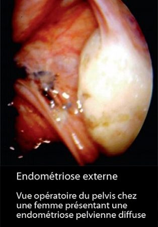 Endométriose externe 2