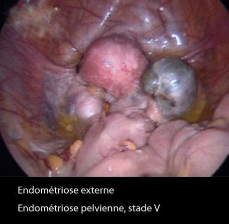 Endométriose externe 3