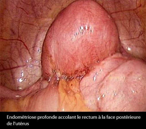 Endométriose externe 4