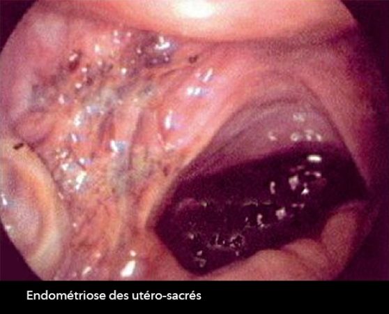 Endométriose externe 5