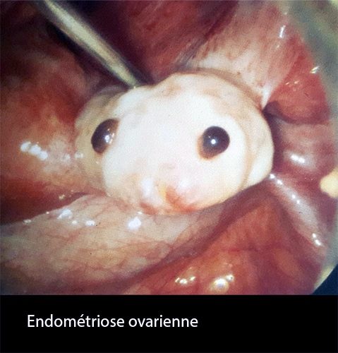 Endométriose ovarienne 1