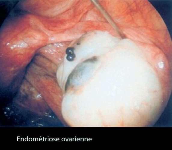 Endométriose ovarienne 2