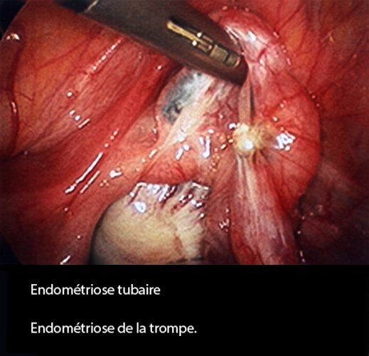 Endométriose tubaire 1