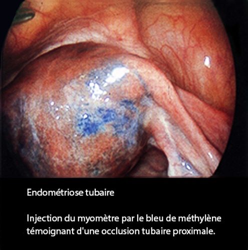 Endométriose tubaire coelioscopie — lésions endométriosiques trompe 2