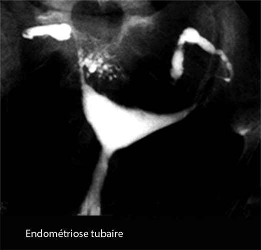 Endométriose tubaire 2