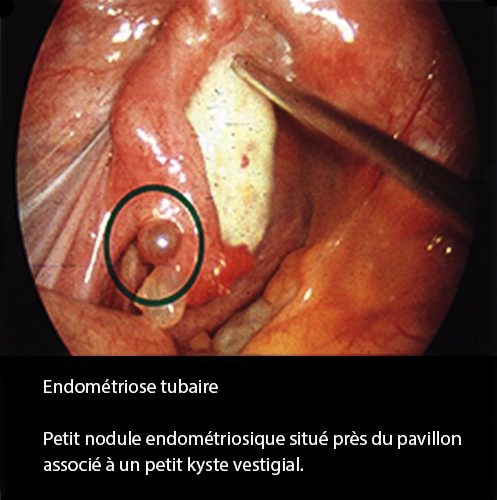 Endométriose tubaire coelioscopie — lésions endométriosiques trompe 3