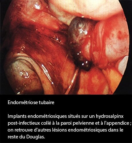 Endométriose tubaire coelioscopie — lésions endométriosiques trompe 4