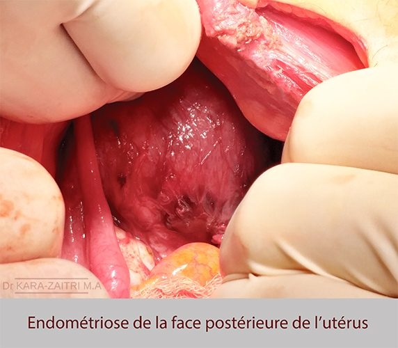 Endométriose utérus