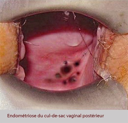 Endométriose vagin