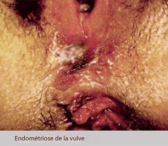 Endométriose vulve