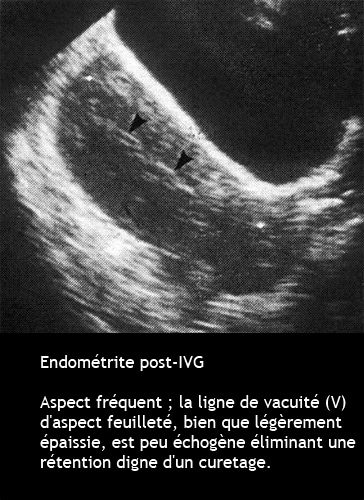Endométrite