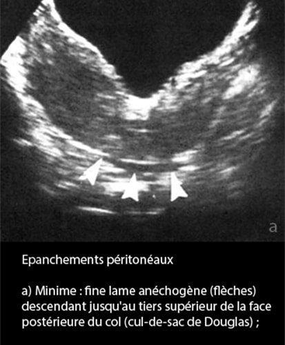 Epanchements péritonéaux 1