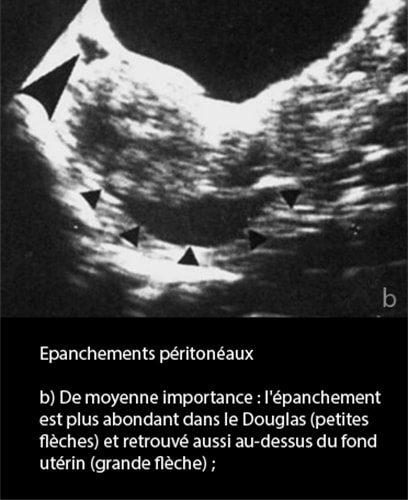 Epanchements péritonéaux 2