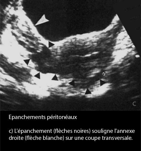 Epanchements péritonéaux 3