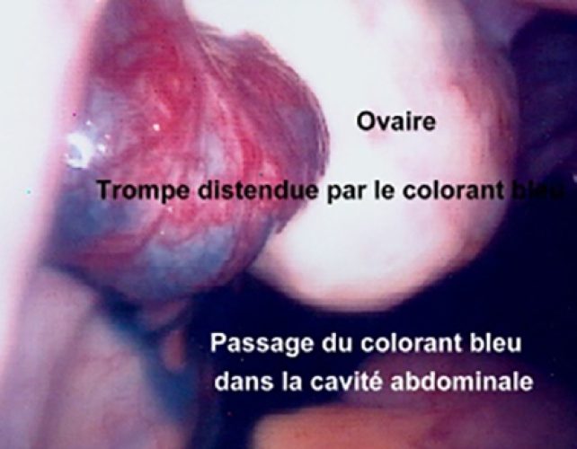 Épreuve au bleu coelioscopie — test de perméabilité tubaire