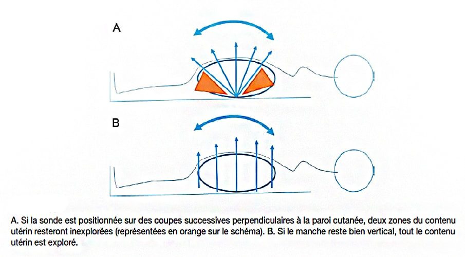 Exploration à la sonde échographique — technique échographie obstétricale