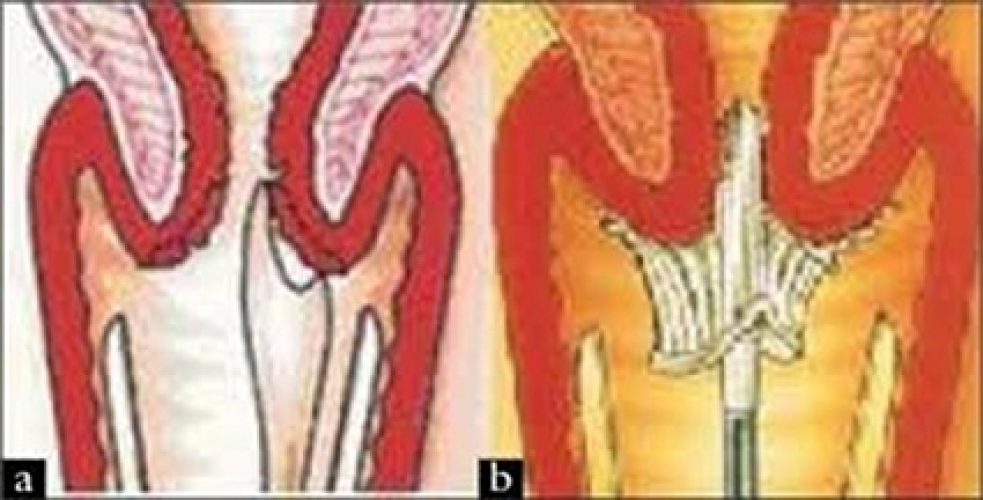Frottis cervico-vaginal