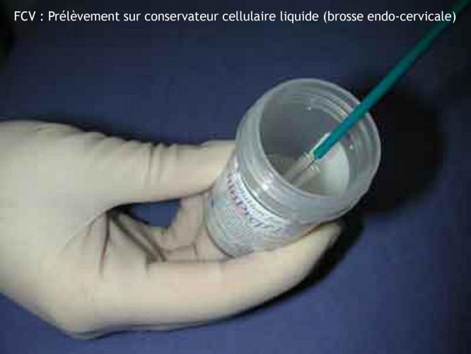 Frottis cervico-vaginal