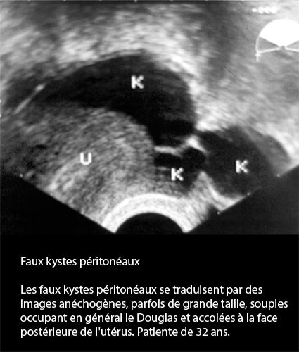 Faux kystes péritonéaux