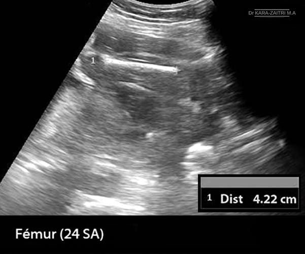 Femur 24 sa
