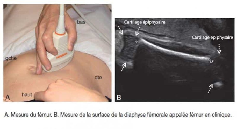 Femur mesure