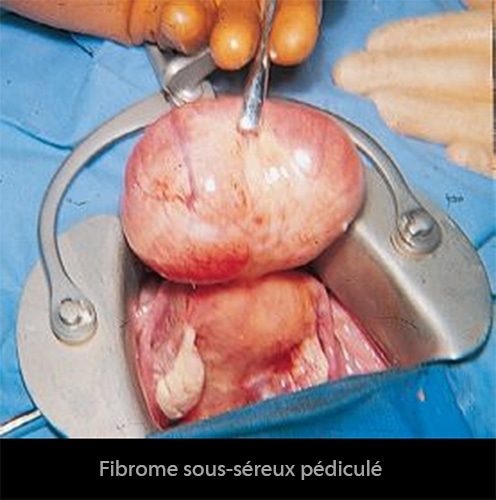 fibromes utérins