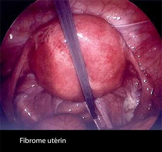 Fibrome 1 coelio