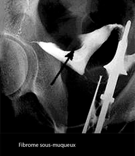 Fibrome 1