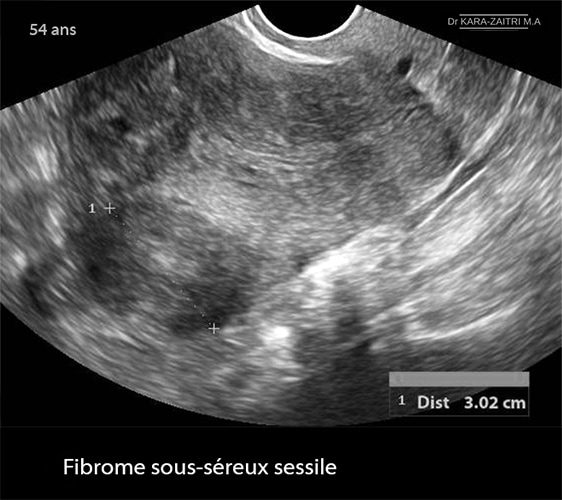 fibromes utérins