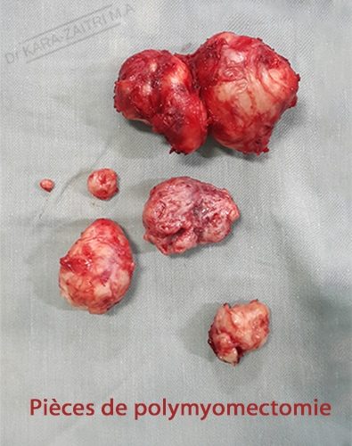 fibromes utérins