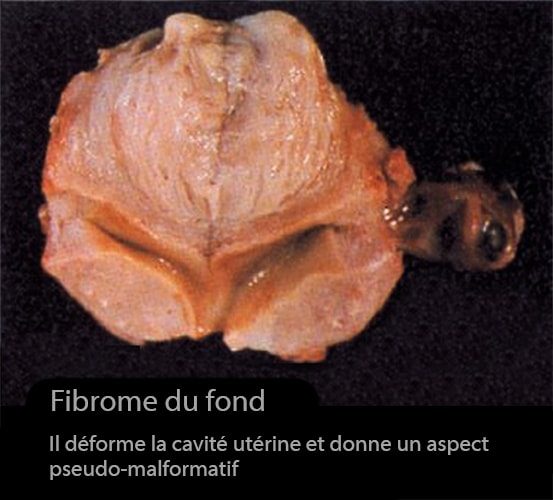 fibromes utérins