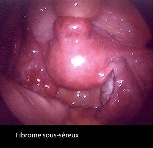 Fibrome 2 coelio