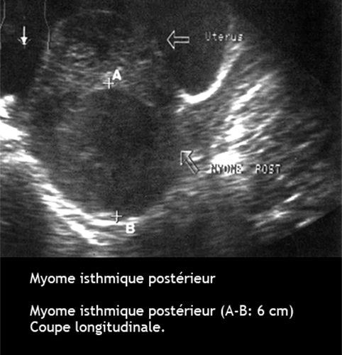 Fibromyomes Utérins : échographie - Dr KARA-ZAITRI M.A