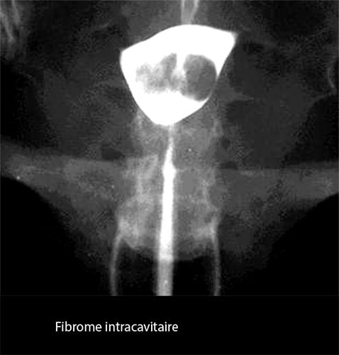 Fibrome 2
