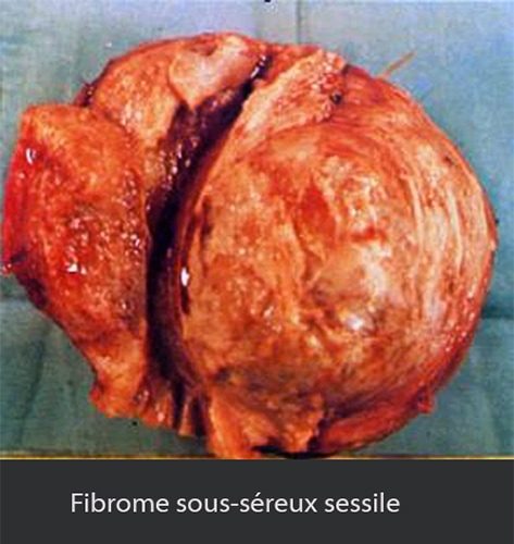 fibromes utérins