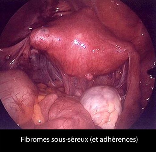 Fibrome 3 coelio