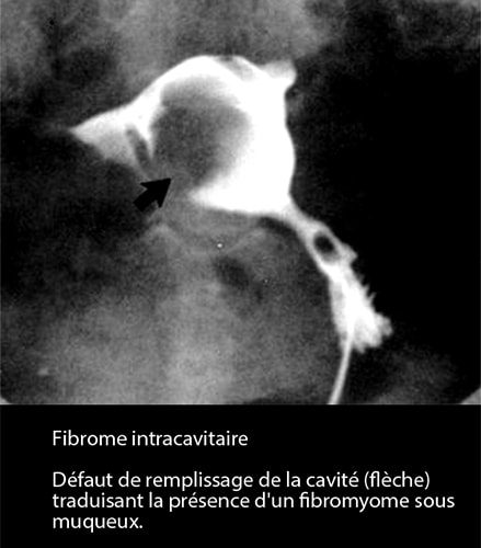 Fibrome 3