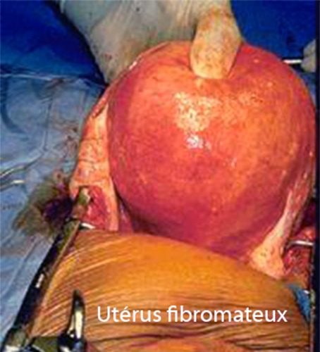 fibromes utérins